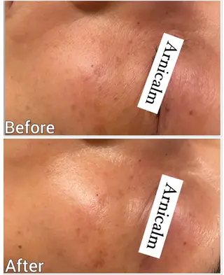 ハーブピーリング 肌再生ピーリング/のエステ・リラクイメージ