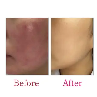 ニキビ・ニキビ跡専門 Solaのエステ・リラクイメージ