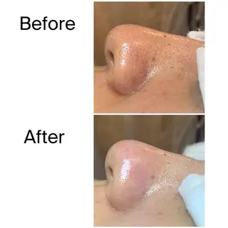 ielu〜毛穴ケア ハーブピーリングのエステ・リラクイメージ