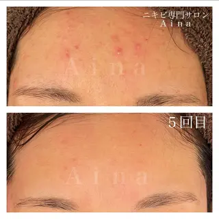 カラー パーマ ヘアアレンジ メンズ キッズ ネイル マツエク・マツパ アイブロウ ニキビ跡専門サロン Ainaのエステ・リラクイメージ