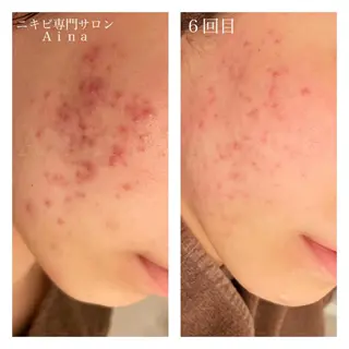 セミロング カラー パーマ ヘアアレンジ メンズ キッズ ネイル マツエク・マツパ ニキビ跡専門サロン Ainaのエステ・リラクイメージ