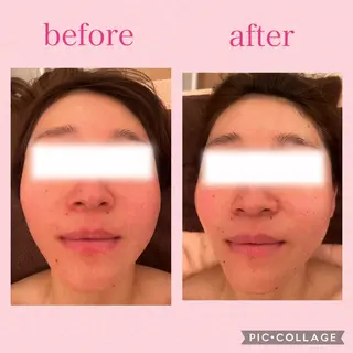 3/25迄ハーブ ピーリングBloomのエステ・リラクイメージ