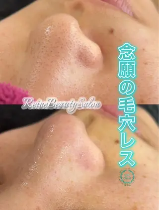 毛穴/シミ肝斑/脱毛 横山梨里のエステ・リラクイメージ