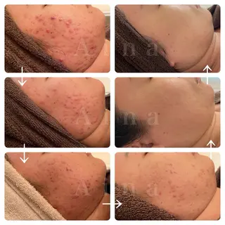 ニキビ跡専門サロン Ａｉｎａのエステ・リラクイメージ