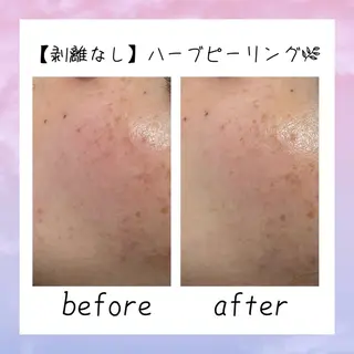 ニキビ 毛穴ケア シャルム ココ みさのエステ・リラクイメージ