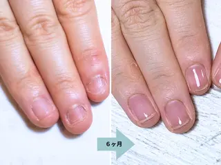 ネイル 深爪矯正・自爪育成 ネイルサロンアモここのネイルデザイン