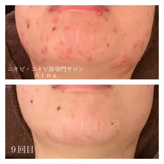 セミロング パーマ ヘアアレンジ メンズ キッズ ネイル マツエク・マツパ アイブロウ ニキビ跡専門サロン Ainaのエステ・リラクイメージ
