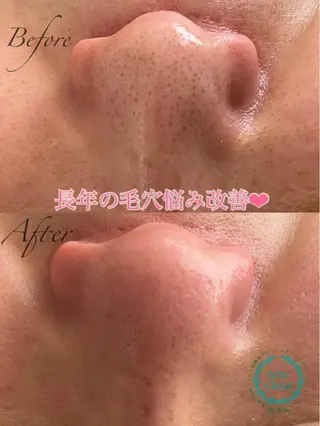 毛穴/シミ肝斑/脱毛 横山梨里のエステ・リラクイメージ