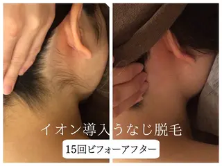 🎀うなじ脱毛🎀 ㅣLino堀江のエステ・リラクイメージ