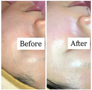 ニキビ/敏感肌/乾燥 Lilyauraのエステ・リラクイメージ