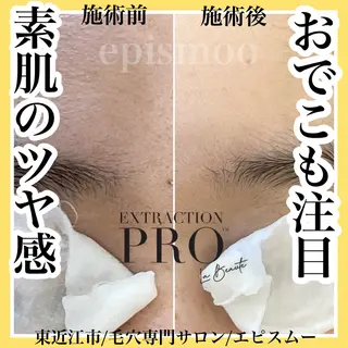 メンズ epismoo 脱毛/HBL/毛穴の眉毛・アイブロウイメージ