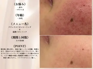 ニキビ跡改善専門🔥 医療にはできない改善のエステ・リラクイメージ