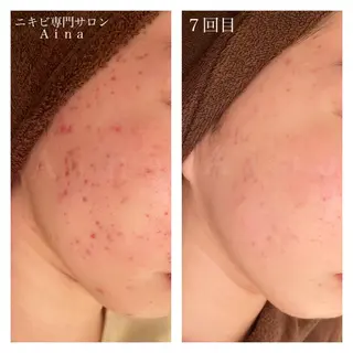 セミロング カラー パーマ ヘアアレンジ メンズ キッズ ネイル マツエク・マツパ ニキビ跡専門サロン Ainaのエステ・リラクイメージ