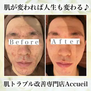 3か月で肌革命👼 ニキビ専門店💫のエステ・リラクイメージ