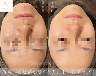 ハーブピーリング専門 サロンドレナ平岡のエステ・リラクイメージ