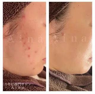セミロング パーマ ヘアアレンジ メンズ キッズ ネイル マツエク・マツパ アイブロウ ニキビ跡専門サロン Ainaのエステ・リラクイメージ