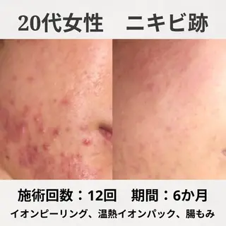 ニキビ跡改善専門🔥 医療にはできない改善のエステ・リラクイメージ