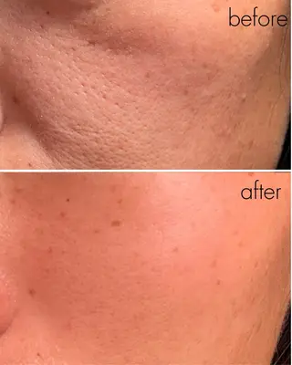 蝶式糸除毛専門salon aco所属・糸除毛専門salon acoのエステ・リラクイメージ