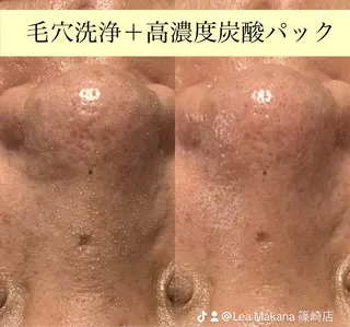 毛穴洗浄🍀脱毛🍀 光フェイシャル🍀のエステ・リラクイメージ