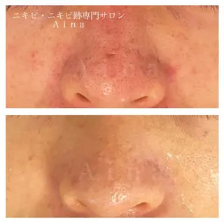 ミディアム パーマ ヘアアレンジ メンズ キッズ ネイル マツエク・マツパ アイブロウ ニキビ跡専門サロン Ainaのエステ・リラクイメージ