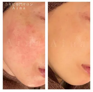 セミロング パーマ ヘアアレンジ メンズ キッズ ネイル マツエク・マツパ アイブロウ ニキビ跡専門サロン Ainaのエステ・リラクイメージ