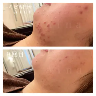 ミディアム カラー パーマ ヘアアレンジ メンズ キッズ ネイル マツエク・マツパ ニキビ跡専門サロン Ainaのエステ・リラクイメージ