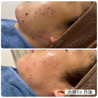 【赤ニキビ改善】 BELL'ET新宿店のエステ・リラクイメージ