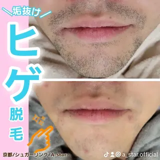 A*《エースター》 シュガーリング🍋のエステ・リラクイメージ