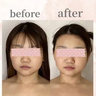 毛穴/いちご鼻/小顔 /hitohanaのエステ・リラクイメージ