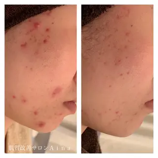 セミロング カラー パーマ ヘアアレンジ メンズ キッズ ネイル マツエク・マツパ ニキビ跡専門サロン Ainaのエステ・リラクイメージ
