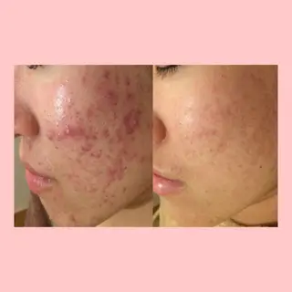 ロング カラー パーマ ヘアアレンジ メンズ キッズ ネイル マツエク・マツパ アイブロウ 3か月で肌革命👼 ニキビ専門店💫のエステ・リラクイメージ