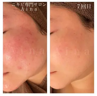 セミロング パーマ ヘアアレンジ メンズ キッズ ネイル マツエク・マツパ アイブロウ ニキビ跡専門サロン Ainaのエステ・リラクイメージ