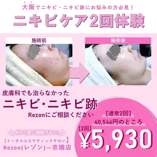 ニキビケア◇ニキビ跡 レゾン京橋店　八崎のエステ・リラクイメージ