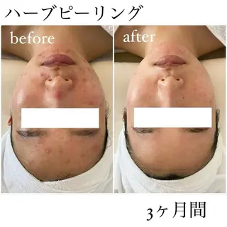 肌質改善／ブライダル I'm.-イム-のエステ・リラクイメージ