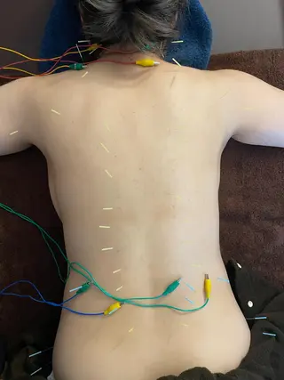 美楽鍼 びらくしんのその他イメージ