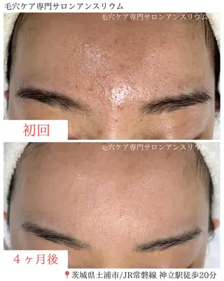 毛穴ケア専門サロンアンスリウム所属・茨城土浦 つくば毛穴 ケア専門サロンのエステ・リラクイメージ