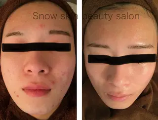 ニキビ/肌質改善専門 Snow skinのエステ・リラクイメージ