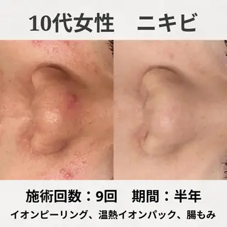 ニキビ特化型エステ 🍋最短で肌質改善のエステ・リラクイメージ
