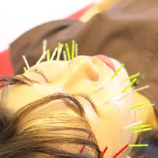 🌈リフトUP美容鍼 🙌 オオシマ🌈のエステ・リラクイメージ