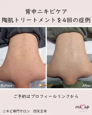 Meupニキビ専門店 背中/ハーブ/肌管理のその他イメージ