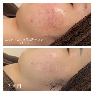カラー パーマ ヘアアレンジ メンズ キッズ ネイル マツエク・マツパ アイブロウ ニキビ跡専門サロン Ainaのエステ・リラクイメージ