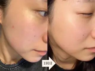 eto.所属・肌質改善サロンeto ニキビ・ニキビ跡のエステ・リラクイメージ