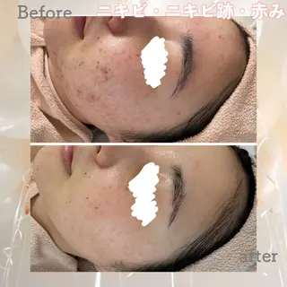 ニキビ&跡改善サロン オーナー光木のエステ・リラクイメージ