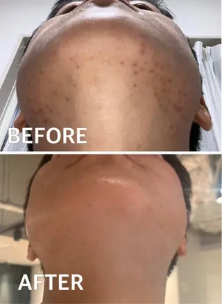 メンズ 大阪脱毛|ちぇるま| 眉毛Wax｜美肌管理のエステ・リラクイメージ