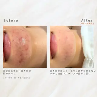 繰り返すニキビ・毛穴 ✨つくば肌質改善専門のエステ・リラクイメージ
