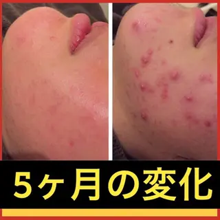 ミディアム カラー パーマ ヘアアレンジ メンズ キッズ ネイル マツエク・マツパ ニキビ・肌質改善専門 ♡人生が変わるサロンのエステ・リラクイメージ