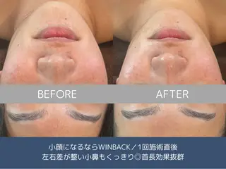 メンズ 艶肌ハーブピーリング /毛穴洗浄のエステ・リラクイメージ