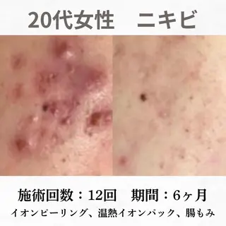 重度ニキビ専門🌷 ダウンタイムなしのエステ・リラクイメージ