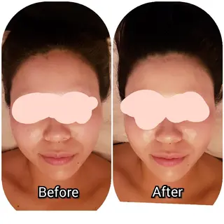 毛穴ケア くすみ肌 ハーブピーリングのエステ・リラクイメージ