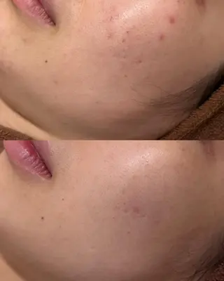 3か月で肌革命👼 ニキビ専門店💫のエステ・リラクイメージ